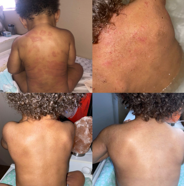 Tubby todd best sale eczema cream